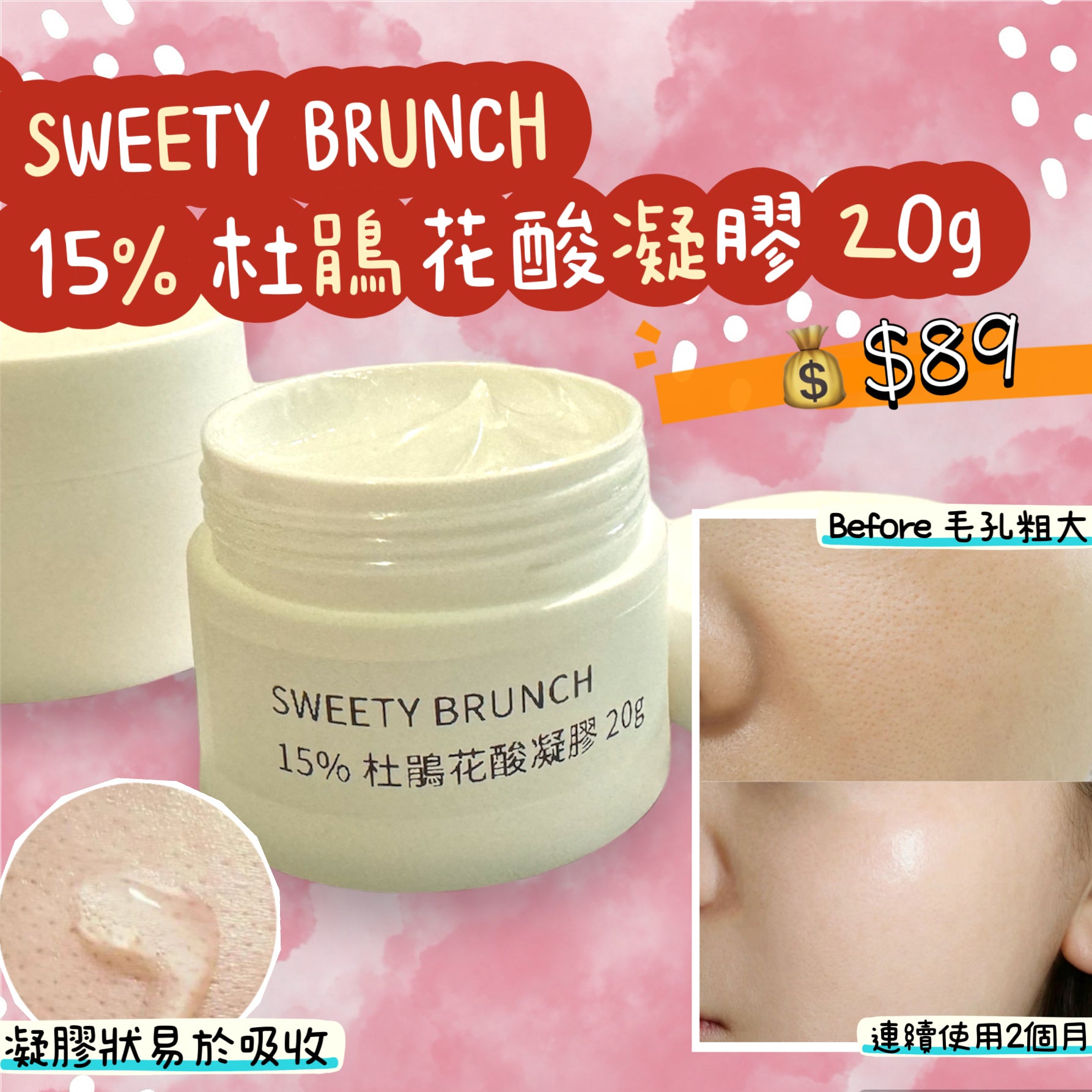 15% Azelaic Acid Gel Cream 杜鵑花酸凝膠