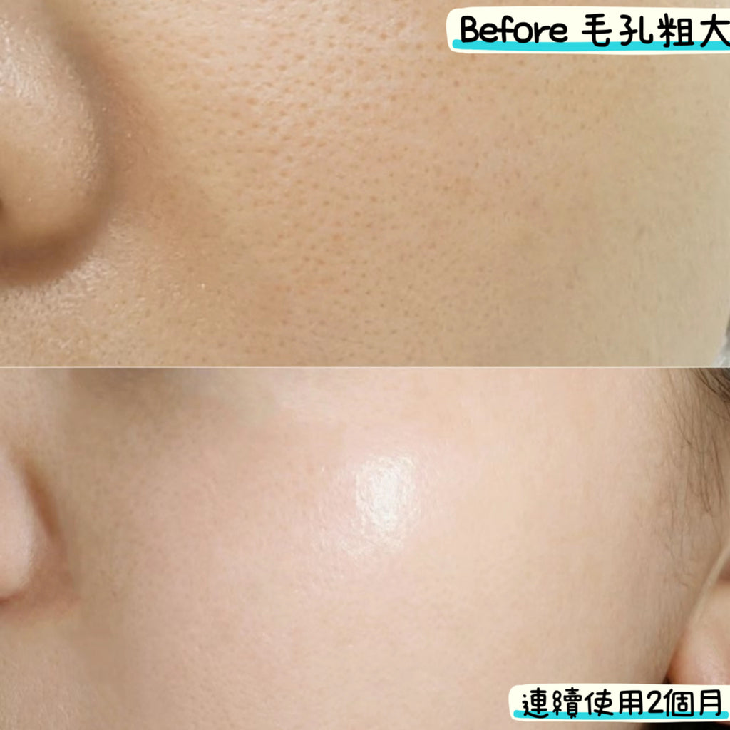 15% Azelaic Acid Gel Cream 杜鵑花酸凝膠