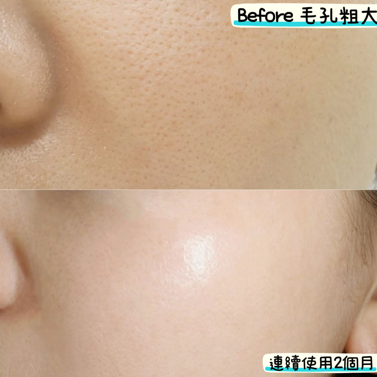 15% Azelaic Acid Gel Cream 杜鵑花酸凝膠