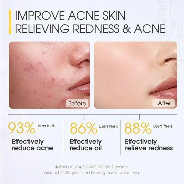 SALICYLIC ACID Acne Treatment Ice Sleep Masque 水楊酸控痘冰感睡眠面膜